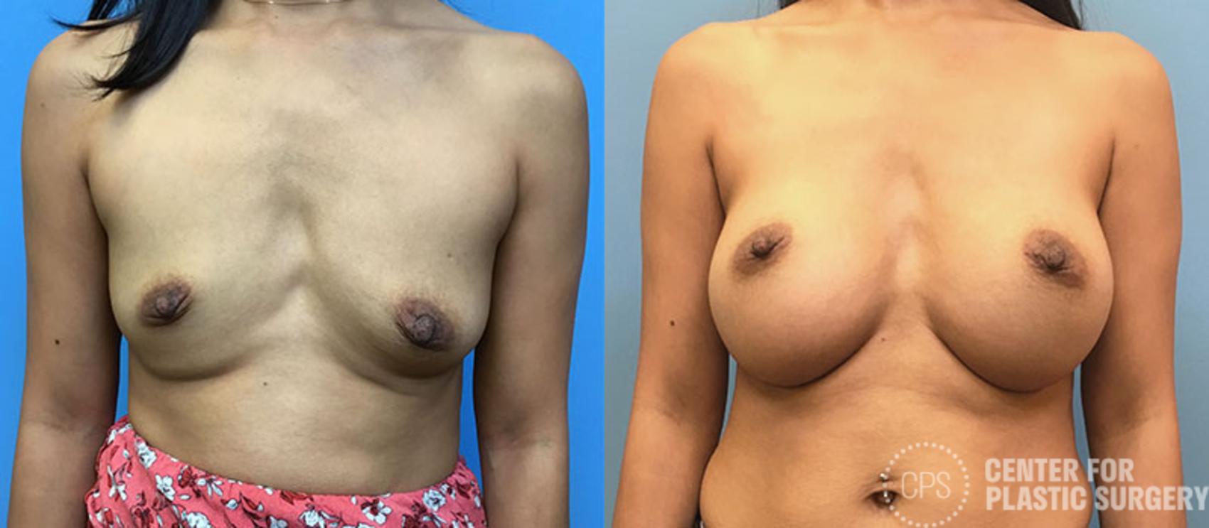 Breast Augmentation Case 90 Before & After Front | Chevy Chase & Annandale, Washington D.C. Metropolitan Area | Center for Plastic Surgery