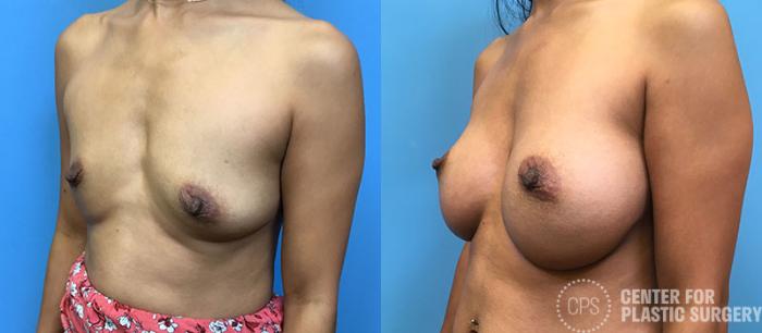 Breast Augmentation Case 90 Before & After Left Oblique | Chevy Chase & Annandale, Washington D.C. Metropolitan Area | Center for Plastic Surgery