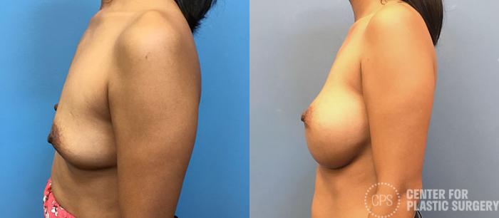 Breast Augmentation Case 90 Before & After Left Side | Chevy Chase & Annandale, Washington D.C. Metropolitan Area | Center for Plastic Surgery