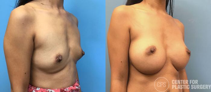 Breast Augmentation Case 90 Before & After Right Oblique | Chevy Chase & Annandale, Washington D.C. Metropolitan Area | Center for Plastic Surgery