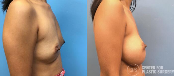 Breast Augmentation Case 90 Before & After Right Side | Chevy Chase & Annandale, Washington D.C. Metropolitan Area | Center for Plastic Surgery