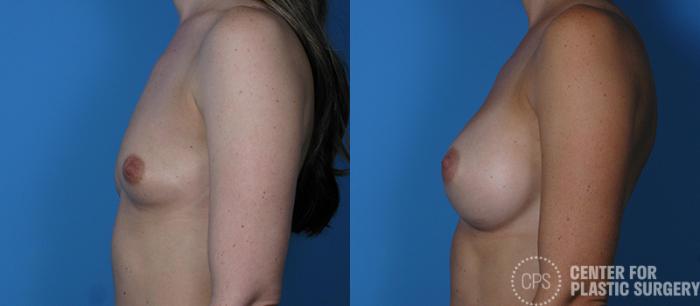 Breast Augmentation Case 92 Before & After Left Side | Chevy Chase & Annandale, Washington D.C. Metropolitan Area | Center for Plastic Surgery
