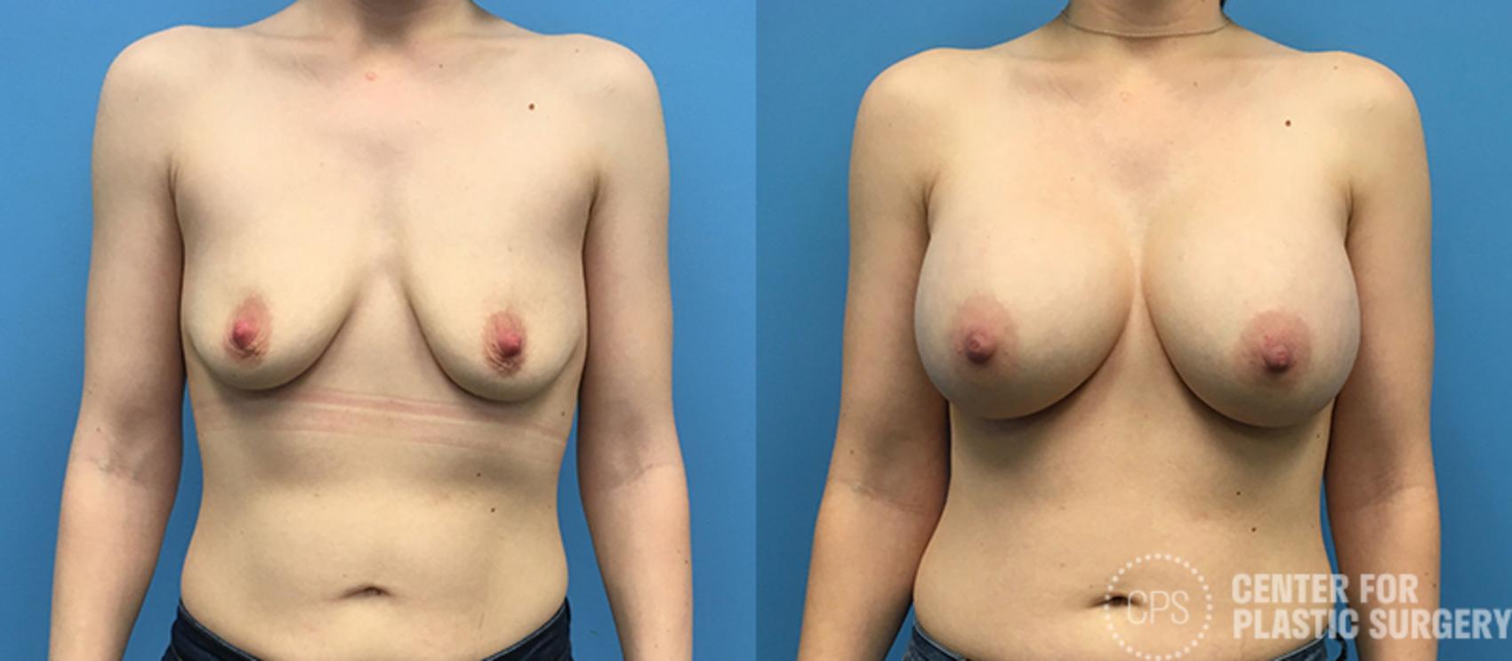 Breast Augmentation Case 93 Before & After Front | Chevy Chase & Annandale, Washington D.C. Metropolitan Area | Center for Plastic Surgery