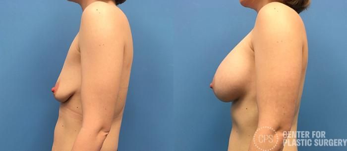 Breast Augmentation Case 93 Before & After Left Side | Chevy Chase & Annandale, Washington D.C. Metropolitan Area | Center for Plastic Surgery