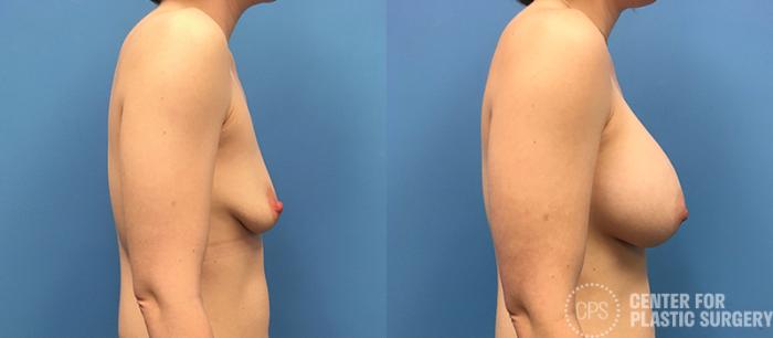 Breast Augmentation Case 93 Before & After Right Side | Chevy Chase & Annandale, Washington D.C. Metropolitan Area | Center for Plastic Surgery