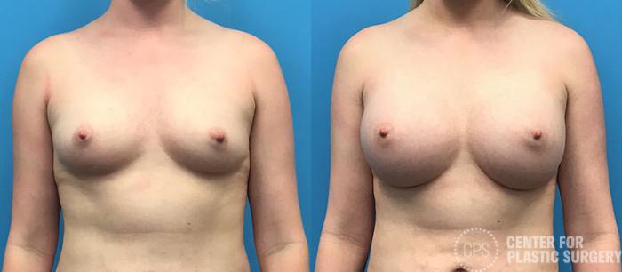 Breast Augmentation Case 94 Before & After Front | Chevy Chase & Annandale, Washington D.C. Metropolitan Area | Center for Plastic Surgery