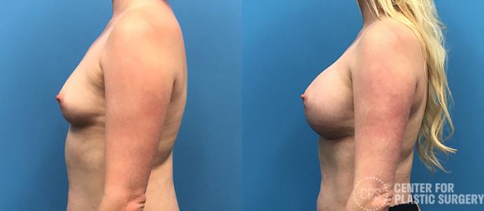 Breast Augmentation Case 94 Before & After Left Side | Chevy Chase & Annandale, Washington D.C. Metropolitan Area | Center for Plastic Surgery