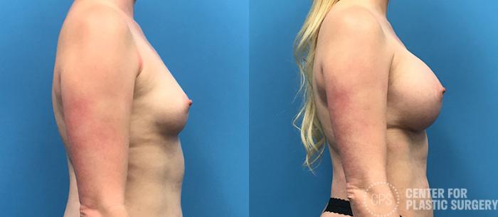 Breast Augmentation Case 94 Before & After Right Side | Chevy Chase & Annandale, Washington D.C. Metropolitan Area | Center for Plastic Surgery