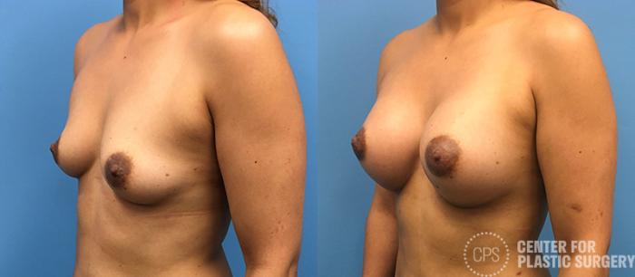 Breast Augmentation Case 95 Before & After Left Oblique | Chevy Chase & Annandale, Washington D.C. Metropolitan Area | Center for Plastic Surgery