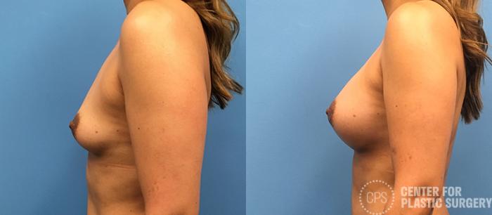 Breast Augmentation Case 95 Before & After Left Side | Chevy Chase & Annandale, Washington D.C. Metropolitan Area | Center for Plastic Surgery