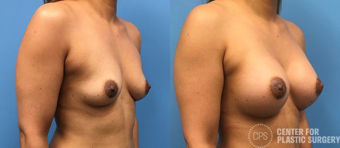 Breast Augmentation Case 95 Before & After Right Oblique | Chevy Chase & Annandale, Washington D.C. Metropolitan Area | Center for Plastic Surgery