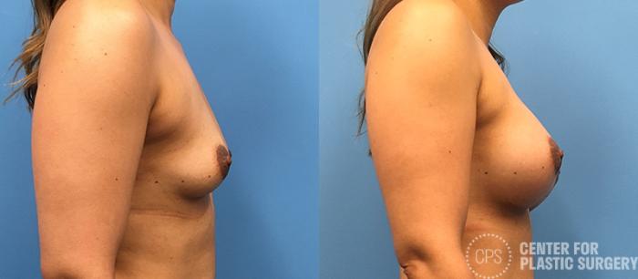 Breast Augmentation Case 95 Before & After Right Side | Chevy Chase & Annandale, Washington D.C. Metropolitan Area | Center for Plastic Surgery