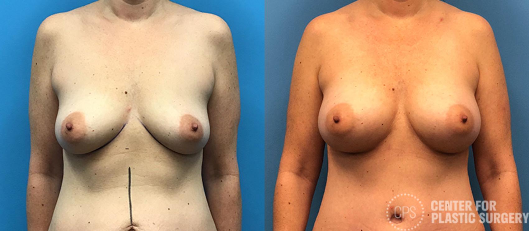 Breast Augmentation Case 96 Before & After Front | Chevy Chase & Annandale, Washington D.C. Metropolitan Area | Center for Plastic Surgery