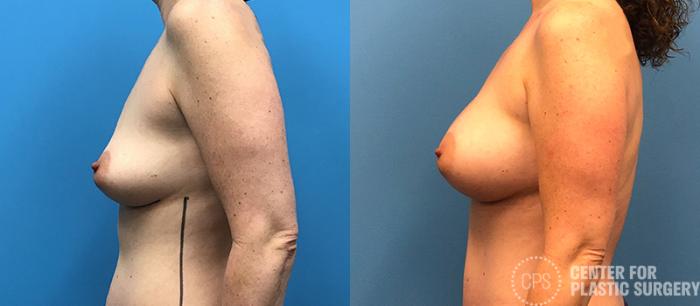 Breast Augmentation Case 96 Before & After Left Side | Chevy Chase & Annandale, Washington D.C. Metropolitan Area | Center for Plastic Surgery