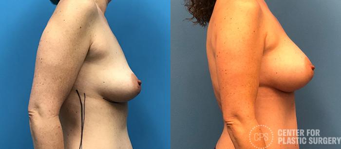 Breast Augmentation Case 96 Before & After Right Side | Chevy Chase & Annandale, Washington D.C. Metropolitan Area | Center for Plastic Surgery