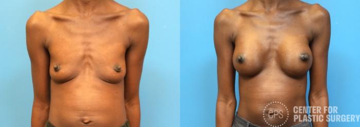 Breast Augmentation Case 97 Before & After Front | Chevy Chase & Annandale, Washington D.C. Metropolitan Area | Center for Plastic Surgery
