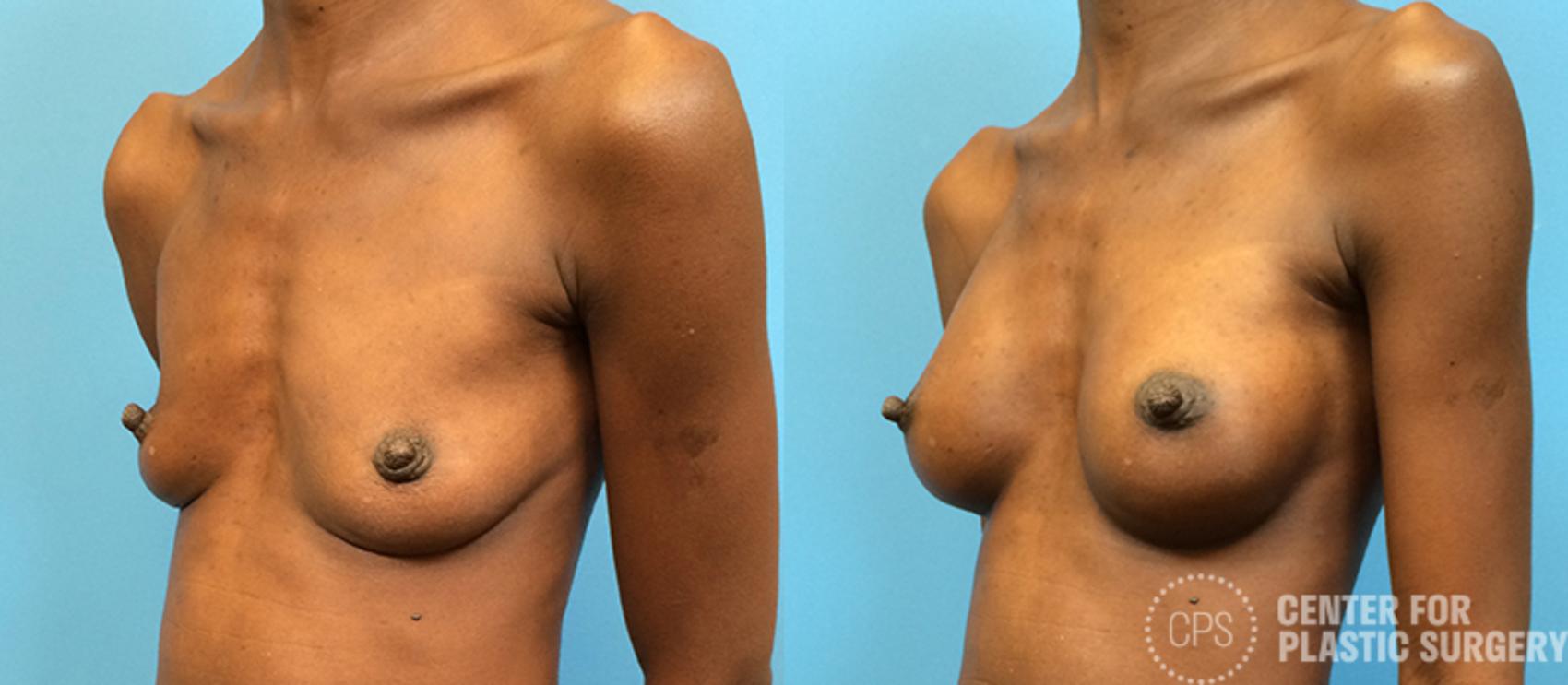 Breast Augmentation Case 97 Before & After Left Oblique | Chevy Chase & Annandale, Washington D.C. Metropolitan Area | Center for Plastic Surgery