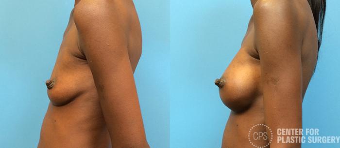 Breast Augmentation Case 97 Before & After Left Side | Chevy Chase & Annandale, Washington D.C. Metropolitan Area | Center for Plastic Surgery
