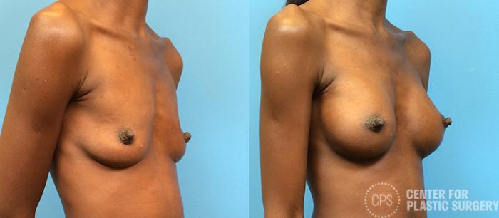 Breast Augmentation Case 97 Before & After Right Oblique | Chevy Chase & Annandale, Washington D.C. Metropolitan Area | Center for Plastic Surgery