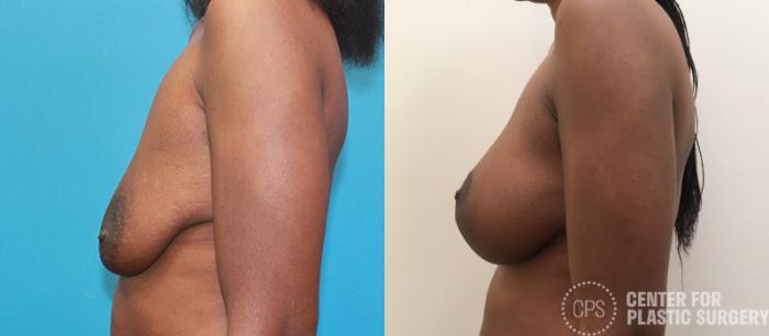 Breast Augmentation with Lift Case 100 Before & After Left Side | Chevy Chase & Annandale, Washington D.C. Metropolitan Area | Center for Plastic Surgery