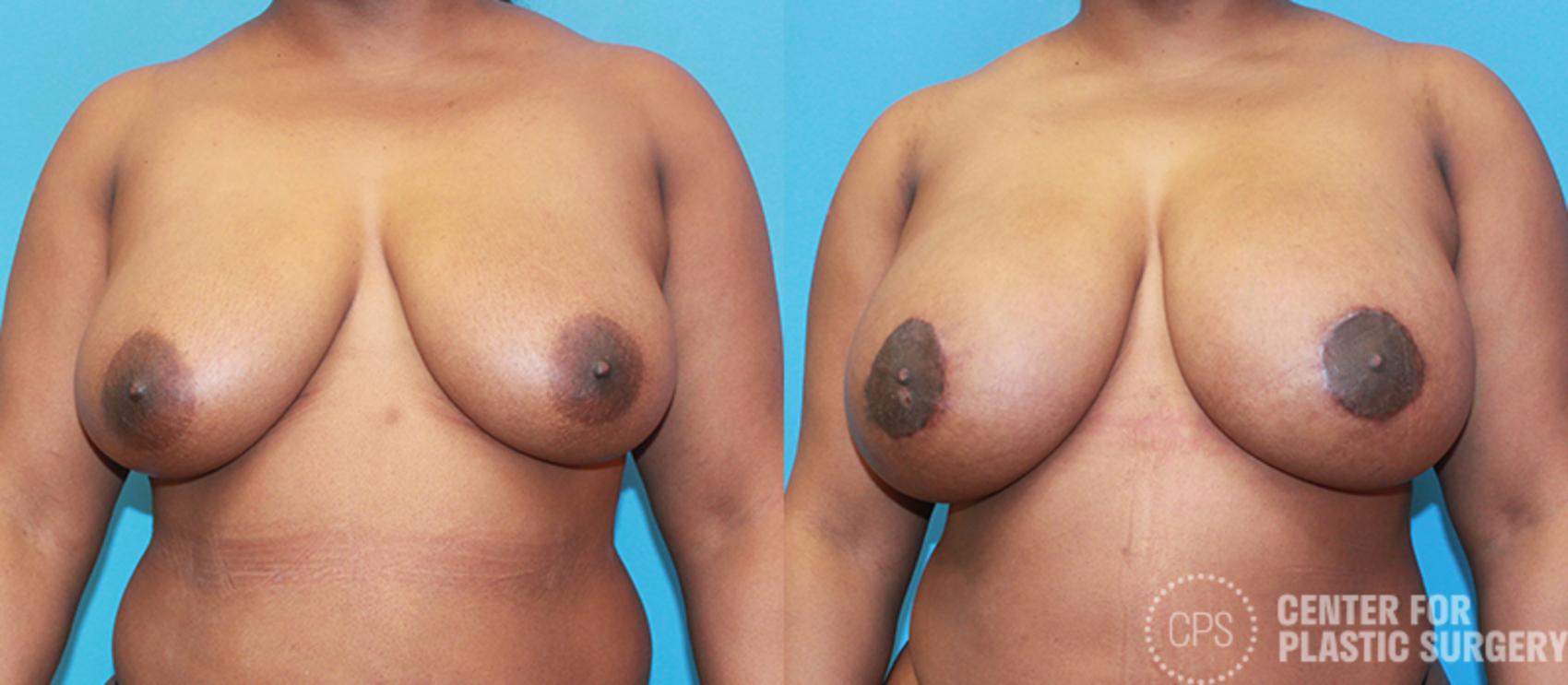 Breast Augmentation with Lift Case 103 Before & After Front | Chevy Chase & Annandale, Washington D.C. Metropolitan Area | Center for Plastic Surgery