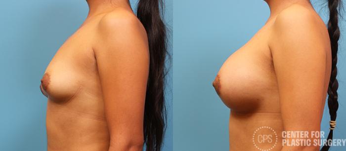 Breast Augmentation with Lift Case 104 Before & After Left Side | Chevy Chase & Annandale, Washington D.C. Metropolitan Area | Center for Plastic Surgery
