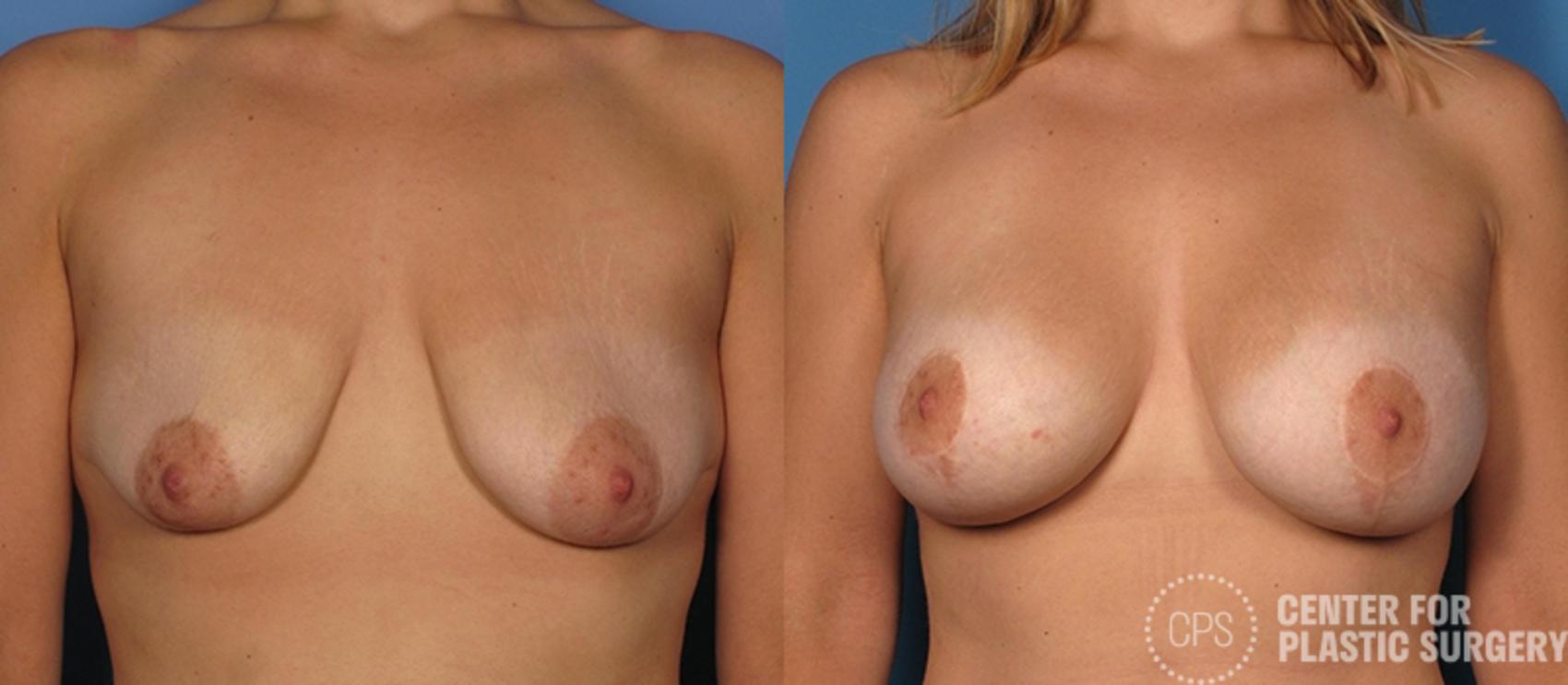Breast Augmentation with Lift Case 107 Before & After Front | Chevy Chase & Annandale, Washington D.C. Metropolitan Area | Center for Plastic Surgery