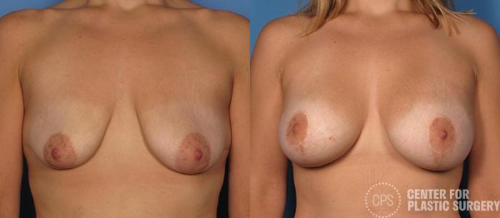 Breast Augmentation with Lift Case 107 Before & After Front | Chevy Chase & Annandale, Washington D.C. Metropolitan Area | Center for Plastic Surgery