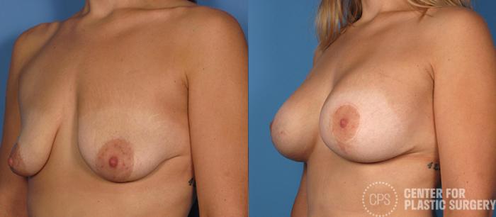 Breast Augmentation with Lift Case 107 Before & After Left Oblique | Chevy Chase & Annandale, Washington D.C. Metropolitan Area | Center for Plastic Surgery