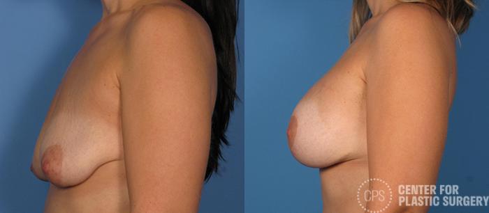 Breast Augmentation with Lift Case 107 Before & After Left Side | Chevy Chase & Annandale, Washington D.C. Metropolitan Area | Center for Plastic Surgery