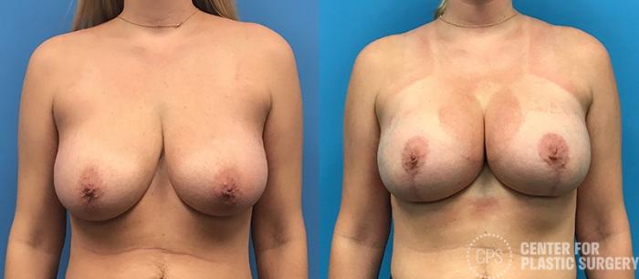 Breast Augmentation with Lift Case 115 Before & After Front | Chevy Chase & Annandale, Washington D.C. Metropolitan Area | Center for Plastic Surgery