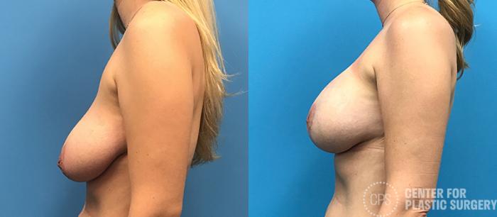 Breast Augmentation with Lift Case 115 Before & After Left Side | Chevy Chase & Annandale, Washington D.C. Metropolitan Area | Center for Plastic Surgery
