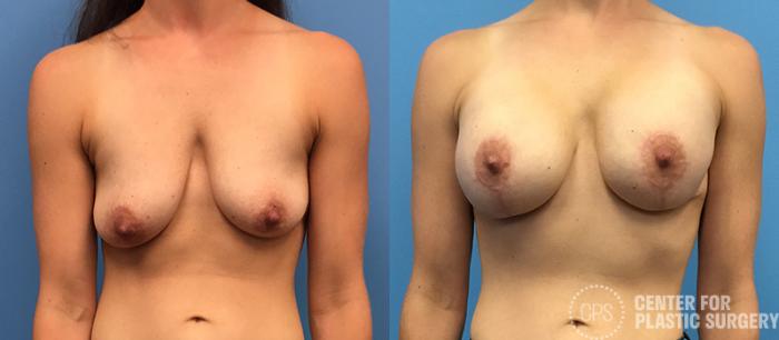Breast Augmentation with Lift Case 118 Before & After Front | Chevy Chase & Annandale, Washington D.C. Metropolitan Area | Center for Plastic Surgery