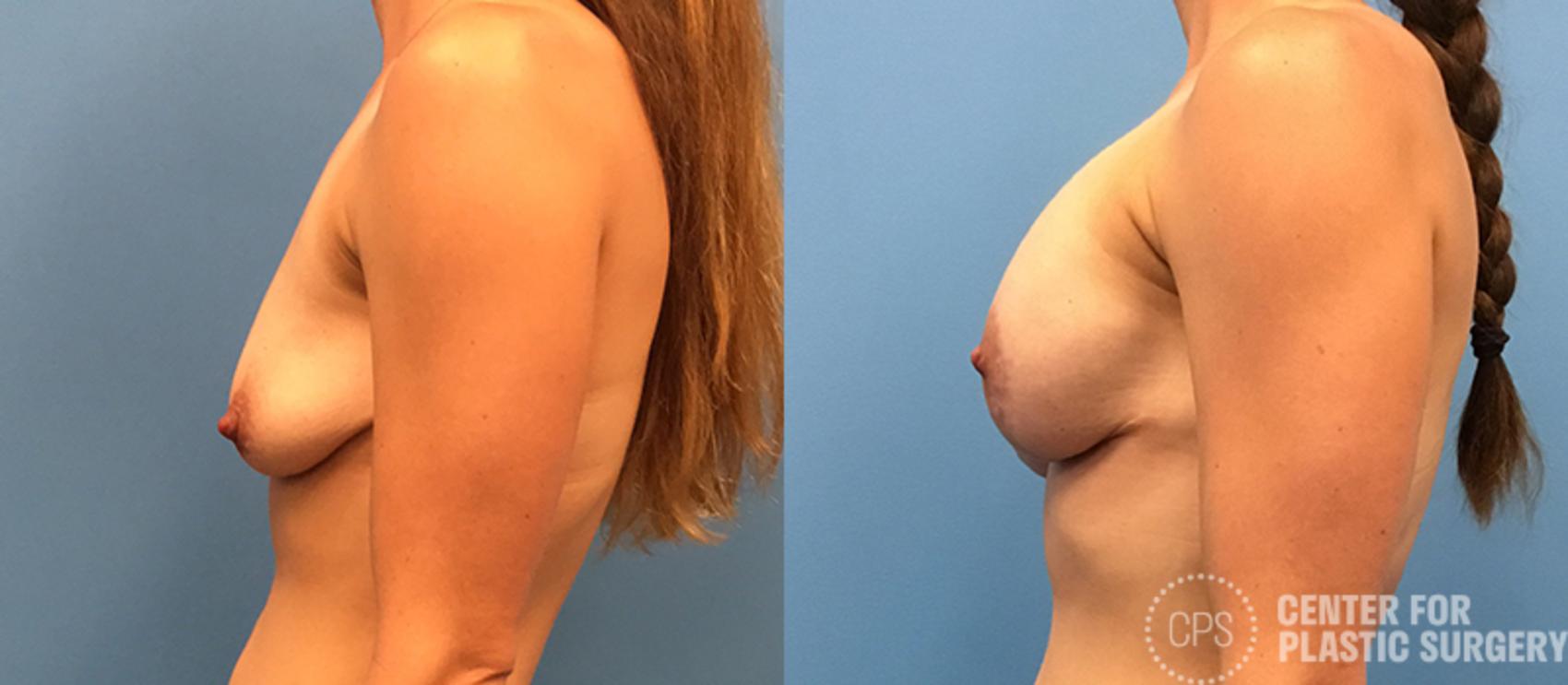Breast Augmentation with Lift Case 118 Before & After Left Side | Annandale, Washington D.C. Metropolitan Area | Center for Plastic Surgery