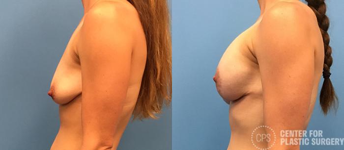 Breast Augmentation with Lift Case 118 Before & After Left Side | Chevy Chase & Annandale, Washington D.C. Metropolitan Area | Center for Plastic Surgery