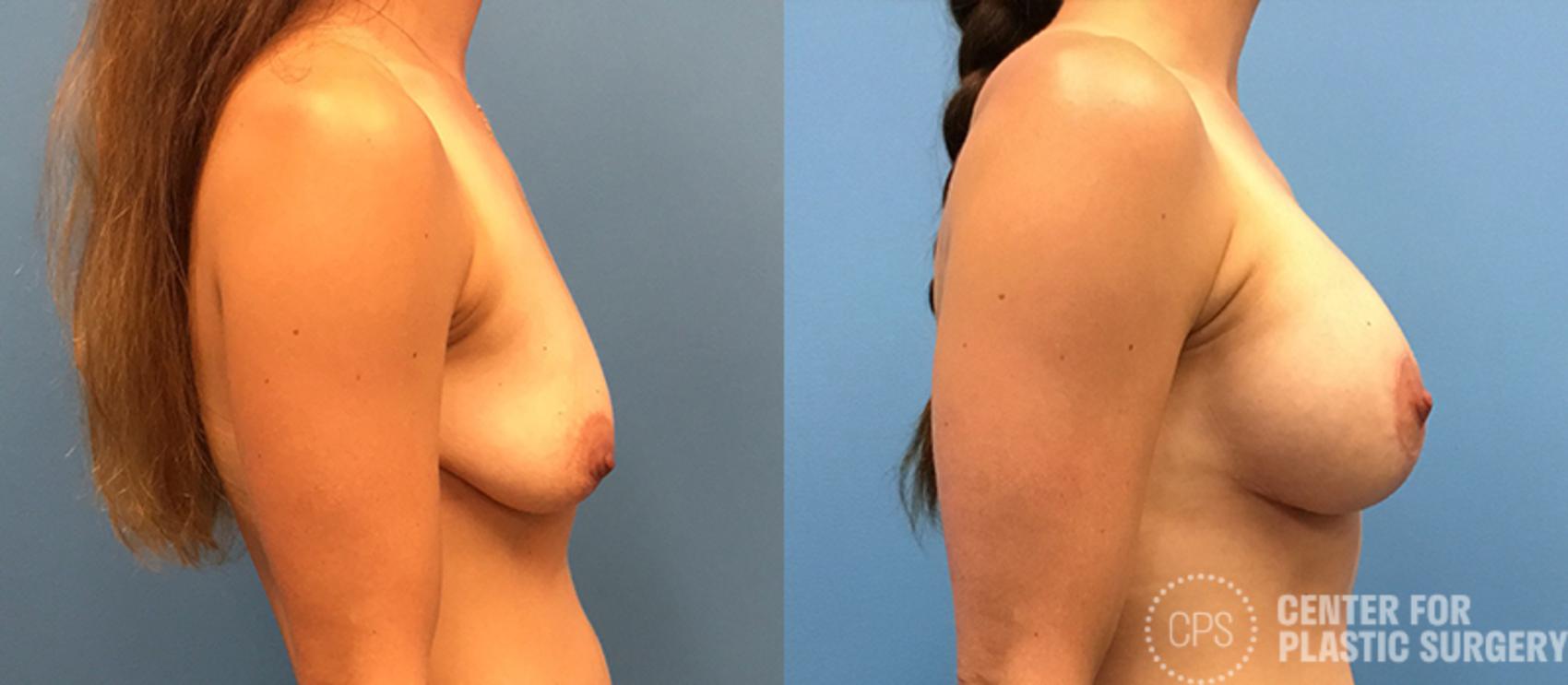 Breast Augmentation with Lift Case 118 Before & After Right Side | Chevy Chase & Annandale, Washington D.C. Metropolitan Area | Center for Plastic Surgery