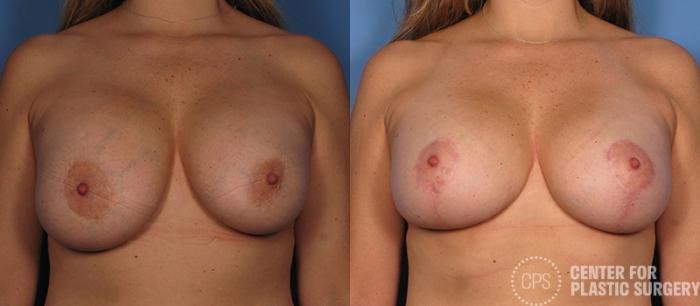 Breast Augmentation with Lift Case 119 Before & After Front | Chevy Chase & Annandale, Washington D.C. Metropolitan Area | Center for Plastic Surgery