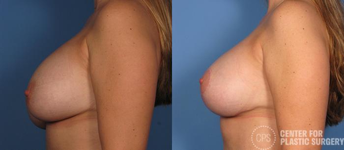 Breast Augmentation with Lift Case 119 Before & After Left Side | Chevy Chase & Annandale, Washington D.C. Metropolitan Area | Center for Plastic Surgery