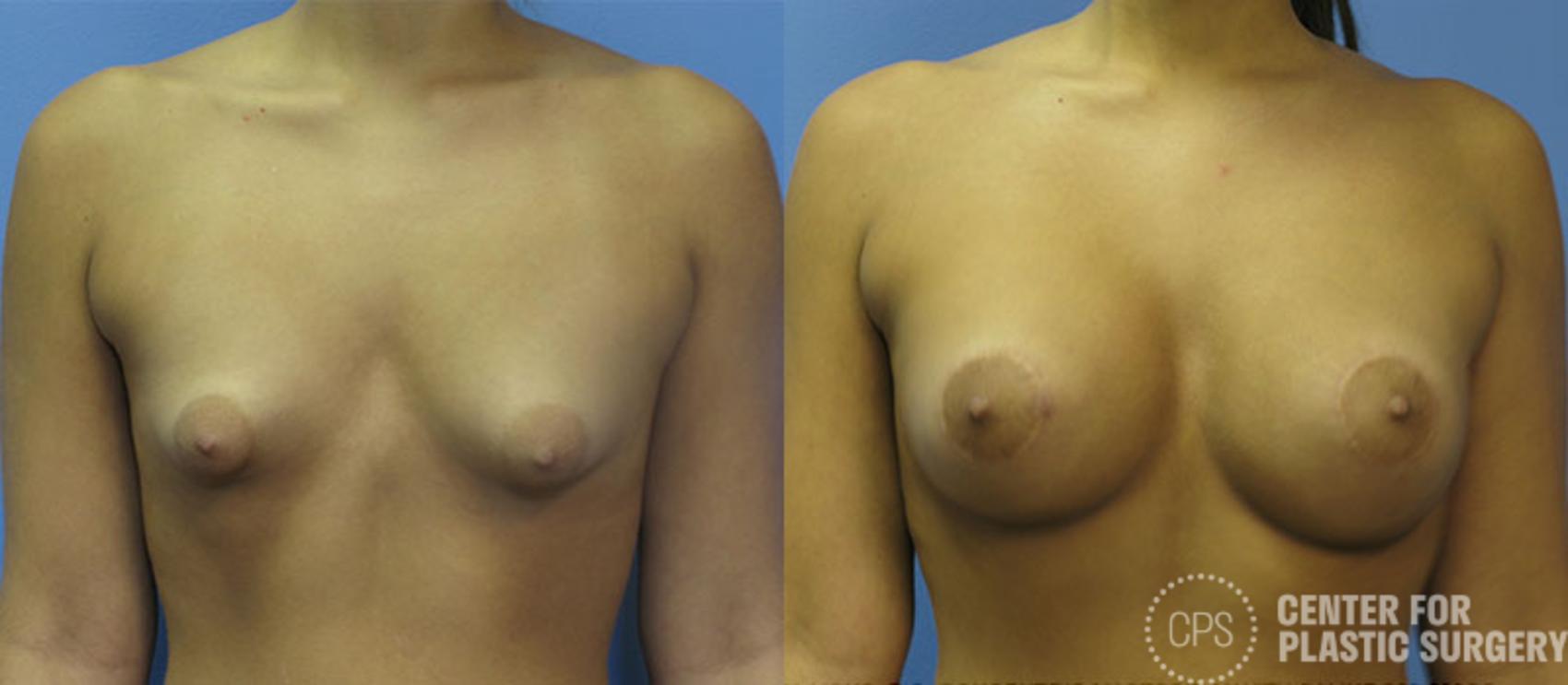 Breast Augmentation with Lift Case 120 Before & After Front | Annandale, Washington D.C. Metropolitan Area | Center for Plastic Surgery