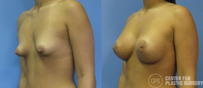 Breast Augmentation with Lift Case 120 Before & After Left Oblique | Chevy Chase & Annandale, Washington D.C. Metropolitan Area | Center for Plastic Surgery
