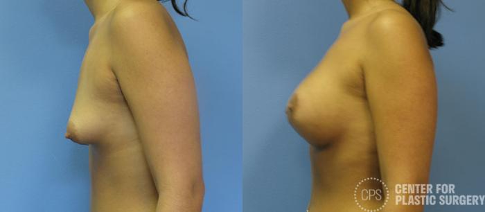 Breast Augmentation with Lift Case 120 Before & After Left Side | Chevy Chase & Annandale, Washington D.C. Metropolitan Area | Center for Plastic Surgery