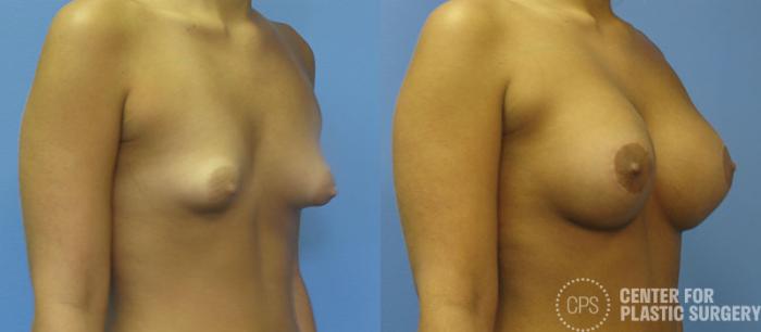 Breast Augmentation with Lift Case 120 Before & After Right Oblique | Chevy Chase & Annandale, Washington D.C. Metropolitan Area | Center for Plastic Surgery