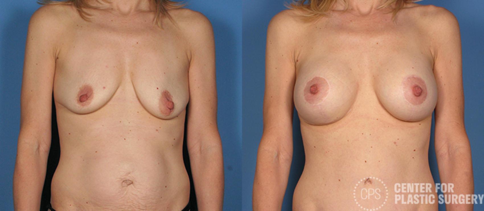 Breast Augmentation with Lift Case 121 Before & After Front | Annandale, Washington D.C. Metropolitan Area | Center for Plastic Surgery