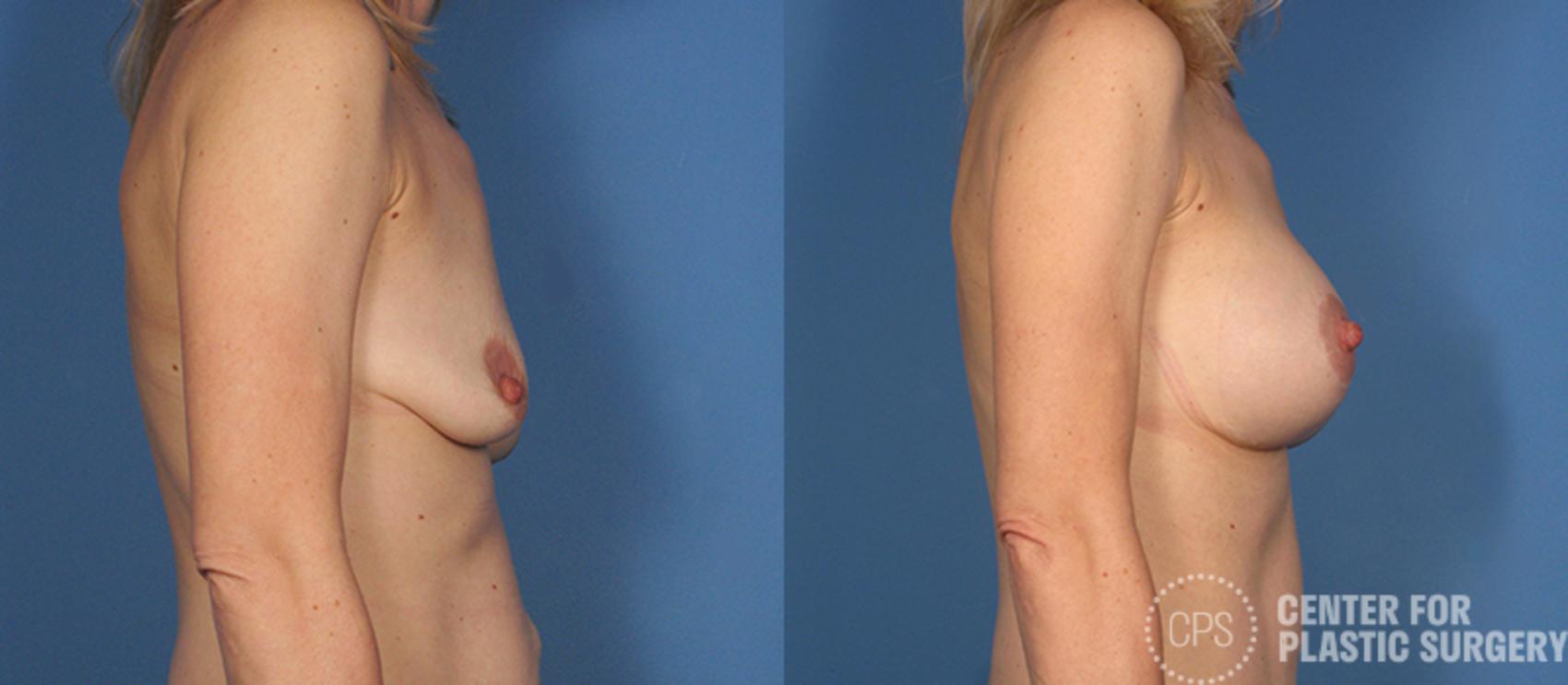 Breast Augmentation with Lift Case 121 Before & After Right Side | Annandale, Washington D.C. Metropolitan Area | Center for Plastic Surgery