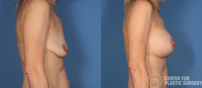 Breast Augmentation with Lift Case 121 Before & After Right Side | Chevy Chase & Annandale, Washington D.C. Metropolitan Area | Center for Plastic Surgery