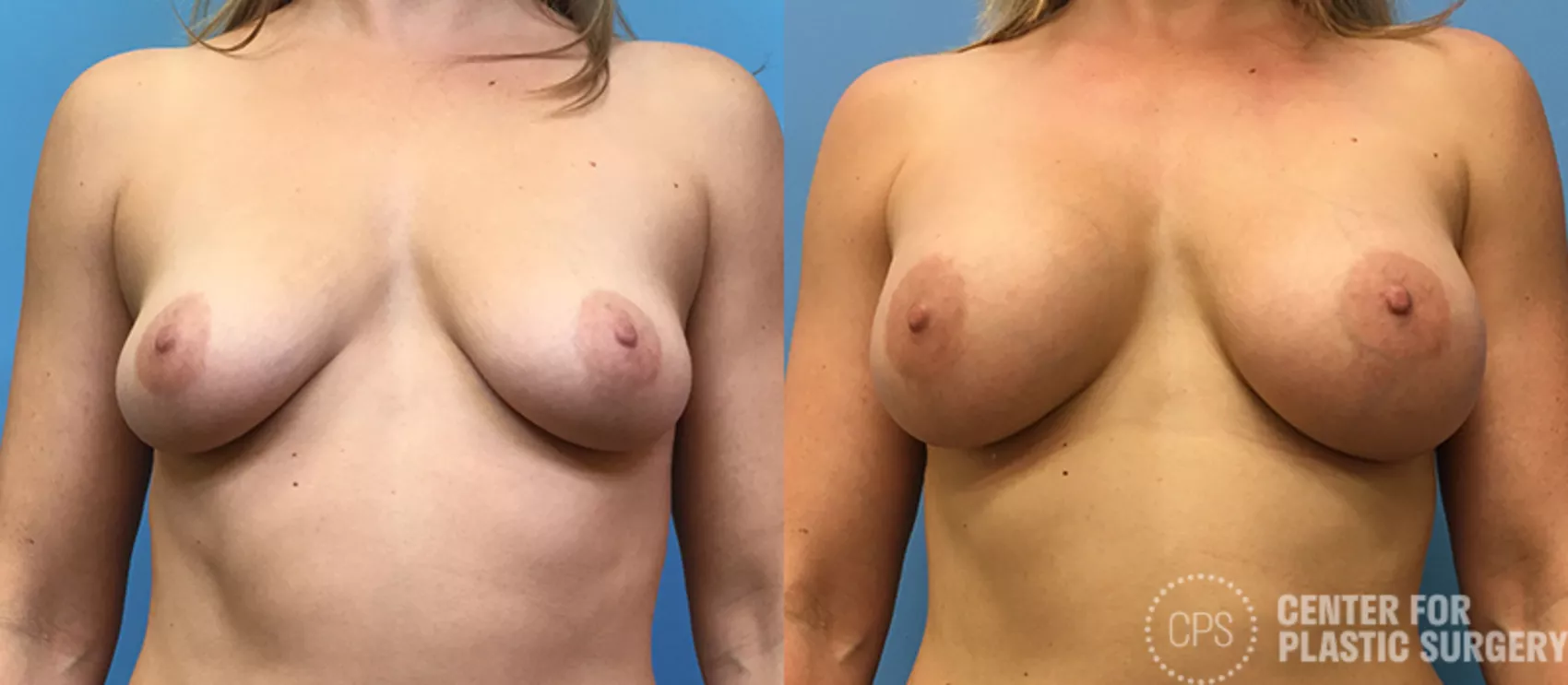 Breast Augmentation with Lift Case 122 Before & After Front | Annandale, Washington D.C. Metropolitan Area | Center for Plastic Surgery