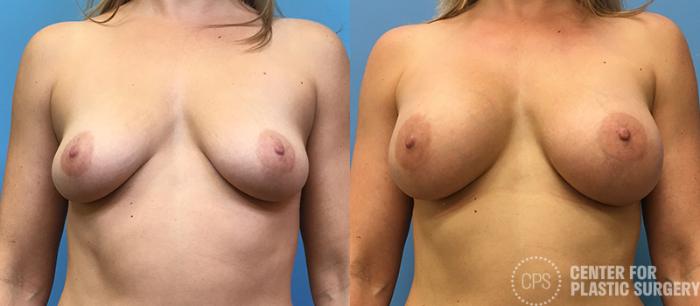 Breast Augmentation with Lift Case 122 Before & After Front | Chevy Chase & Annandale, Washington D.C. Metropolitan Area | Center for Plastic Surgery