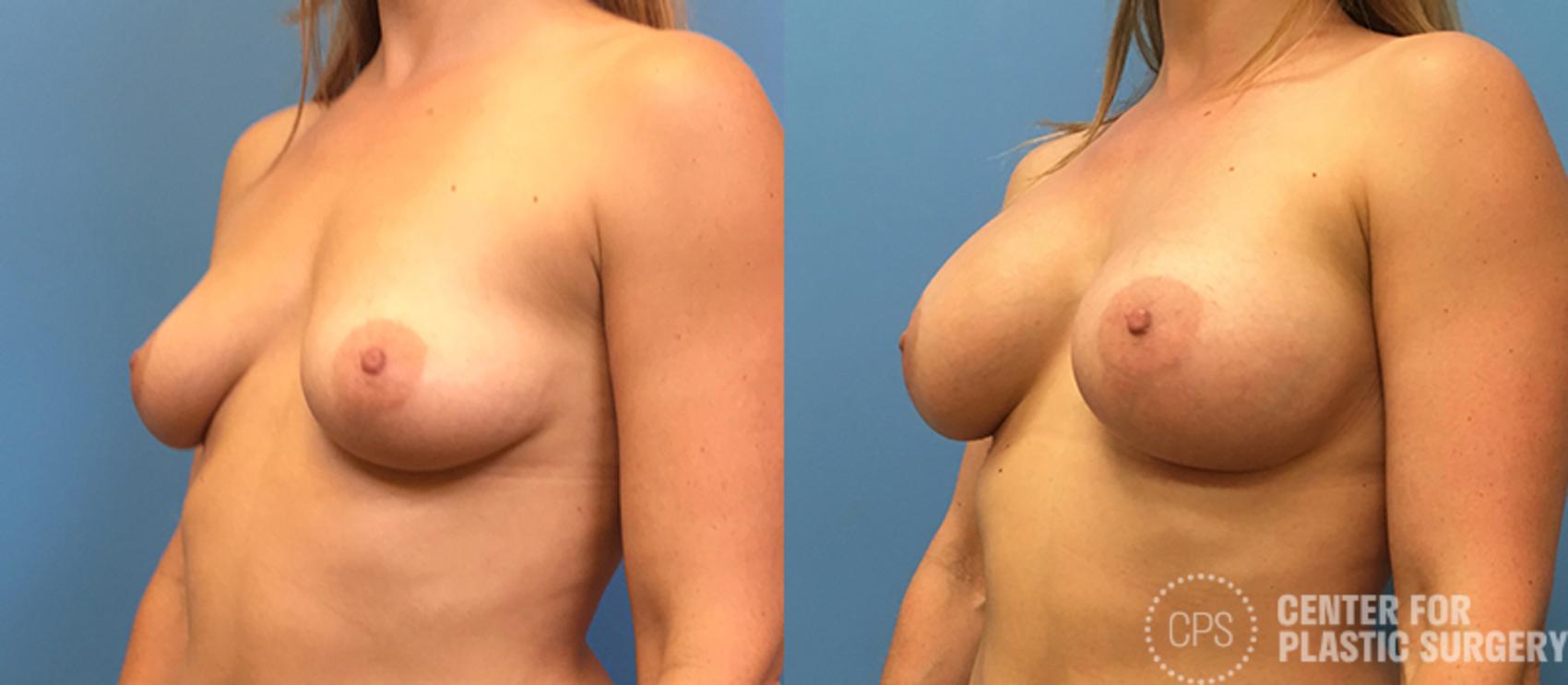 Breast Augmentation with Lift Case 122 Before & After Left Oblique | Annandale, Washington D.C. Metropolitan Area | Center for Plastic Surgery