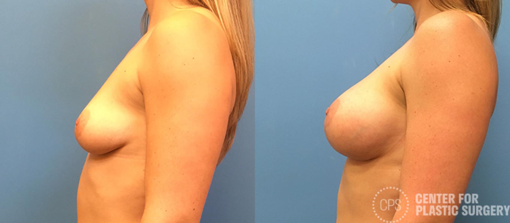 Breast Augmentation with Lift Case 122 Before & After Left Side | Annandale, Washington D.C. Metropolitan Area | Center for Plastic Surgery