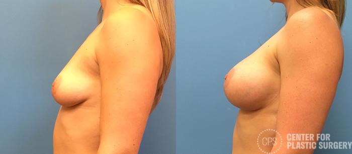 Breast Augmentation with Lift Case 122 Before & After Left Side | Chevy Chase & Annandale, Washington D.C. Metropolitan Area | Center for Plastic Surgery